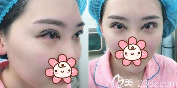 眼綜合做完第二天眼部充血腫脹 眼綜合做完第二天眼部充血腫脹