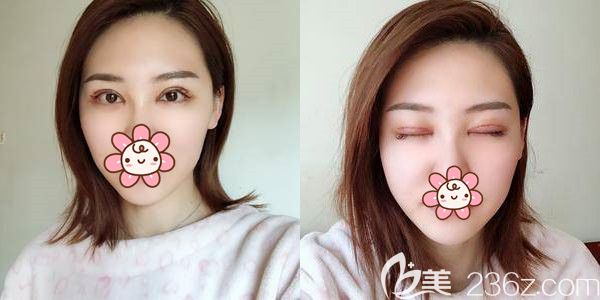 術(shù)后六天眼綜合恢復(fù)情況 術(shù)后六天眼綜合恢復(fù)情況