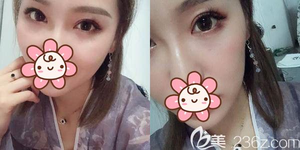 兩千到兩萬不等的雙眼皮，在南京華美做了才知道價(jià)格相差在眼綜合項(xiàng)目