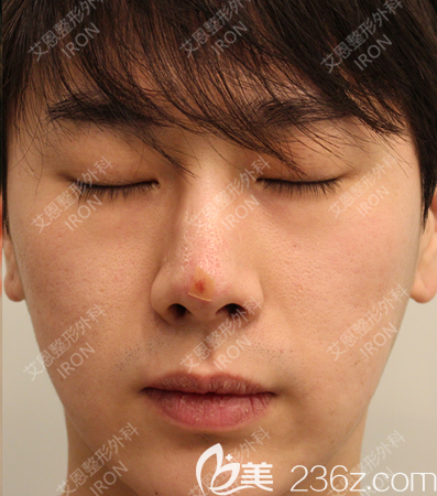 艾恩整形術(shù)后第7天 艾恩整形術(shù)后第7天