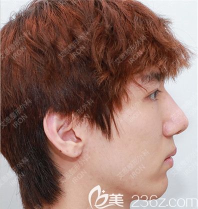 駝峰鼻嚴重影響我的顏值崔源哲手術(shù)后秒變靚仔