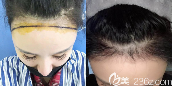 鄭州醫(yī)德佳不剃發(fā)植發(fā)案例效果圖