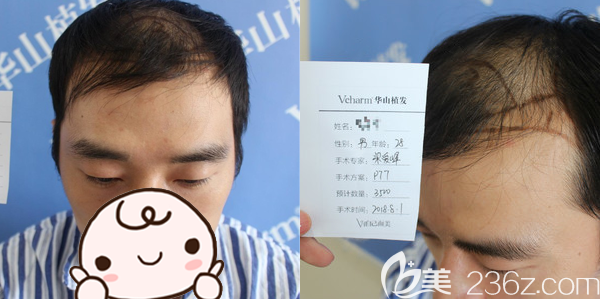 鄭州醫(yī)德佳梁愛峰頭頂加密種植手術(shù)方案 鄭州醫(yī)德佳梁愛峰頭頂加密種植手術(shù)方案