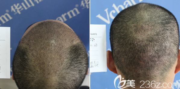 加密種植3500單位術(shù)后10天恢復(fù)效果 加密種植3500單位術(shù)后10天恢復(fù)效果