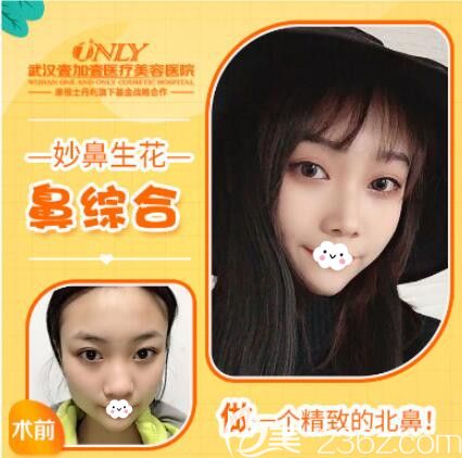 武漢壹加壹自體肋軟骨隆鼻案例