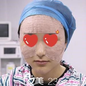 這是我做脂肪填充面部術后即刻的樣子 這是我做脂肪填充面部術后即刻的樣子
