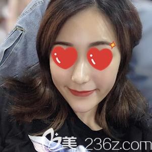 做自體脂肪填充面部術后22天腫脹消40%左右 做自體脂肪填充面部術后22天腫脹消40%左右