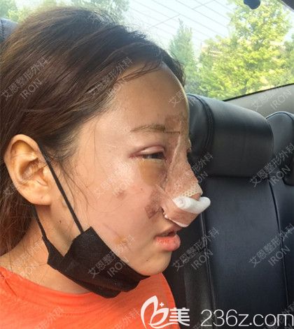 艾恩整形手術(shù)當(dāng)天 艾恩整形手術(shù)當(dāng)天