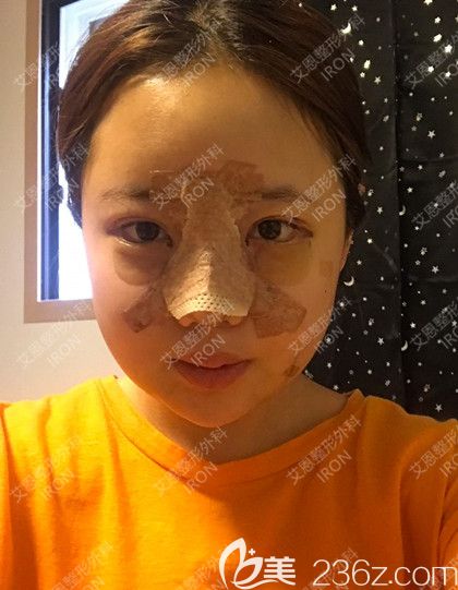 艾恩整形術(shù)后第6天 艾恩整形術(shù)后第6天