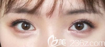 埋線雙眼皮一年后效果
