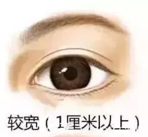 10毫米全切雙眼皮恢復(fù)后