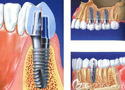 種植牙跟骨結(jié)合 種植牙跟骨結(jié)合