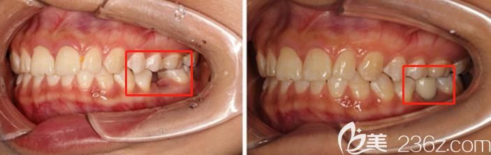 聽別人說種牙3年就壞了,那為啥我在廣州陽光樹口腔做完種植牙超過10年了還好好的