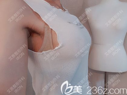 艾恩整形術(shù)后第7天 艾恩整形術(shù)后第7天