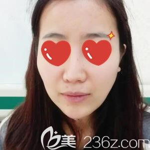 做自體脂肪面部填充前的自己 做自體脂肪面部填充前的自己