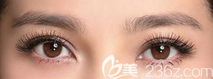 埋線雙眼皮術(shù)后效果圖