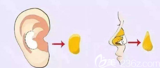 雖然鼻中隔軟骨隆鼻的吸收率只有2%左右但是大量取出會(huì)讓鼻子失去支撐力