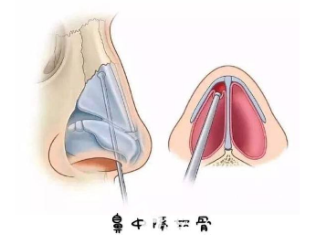 雖然鼻中隔軟骨隆鼻的吸收率只有2%左右但是大量取出會(huì)讓鼻子失去支撐力