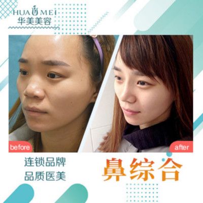 汕頭華美整形醫(yī)院隆鼻案例