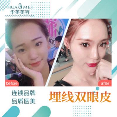 汕頭華美整形醫(yī)院雙眼皮案例
