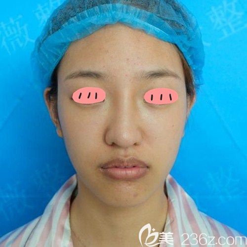 商丘冰薇假體隆鼻術(shù)前照片 商丘冰薇假體隆鼻術(shù)前照片