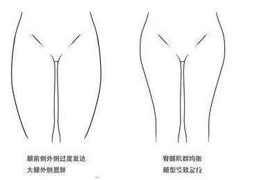 大腿吸脂術(shù)后暴飲暴食體重還是會(huì)反彈但只是脂肪細(xì)胞體積增大了