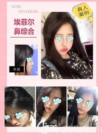 征集到三例銅陵晶美整形案例，看硅膠假體+自體軟骨隆鼻的真實恢復(fù)過程