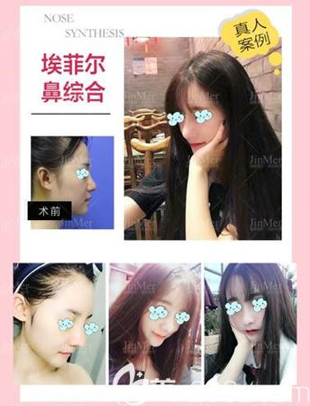 丁院長改善鼻頭肥大選擇硅膠假體+自體軟骨鼻綜合