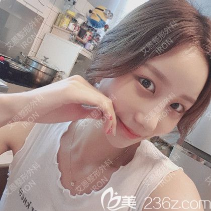 艾恩整形術(shù)后第15天 艾恩整形術(shù)后第15天