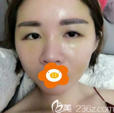 術(shù)后第8天拆線 術(shù)后第8天拆線