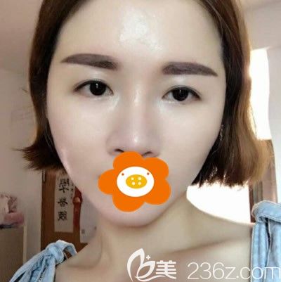 全臉填充半個(gè)月臉還有點(diǎn)腫 全臉填充半個(gè)月臉還有點(diǎn)腫