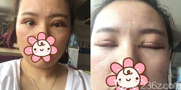 面診連云港華美醫(yī)生做了切開修復(fù)