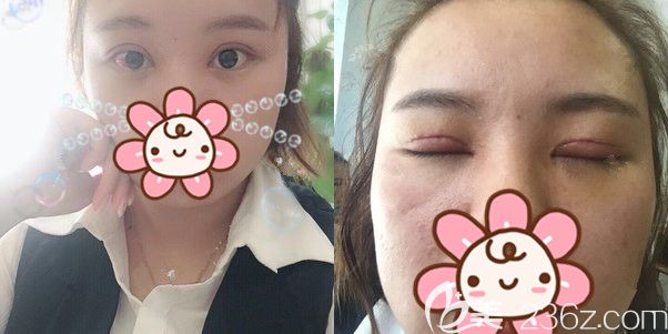 術(shù)后三天輕微消腫的雙眼皮