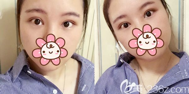 切開重瞼修復(fù)術(shù)后半個月恢復(fù)