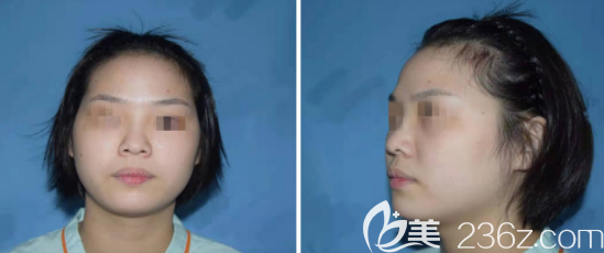 值得開心的是我在濟(jì)南藝星做面部自體脂肪填充的后鼻梁都變得高挺了很多 值得開心的是我在濟(jì)南藝星做面部自體脂肪填充的后鼻梁都變得高挺了很多