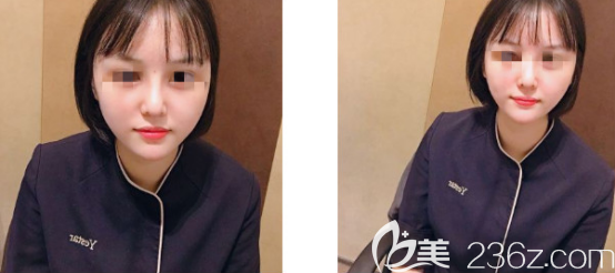 值得開心的是我在濟(jì)南藝星做面部自體脂肪填充的后鼻梁都變得高挺了很多 值得開心的是我在濟(jì)南藝星做面部自體脂肪填充的后鼻梁都變得高挺了很多