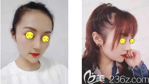 假體隆鼻失敗歪斜在合肥藝星做肋軟骨鼻綜合修復過程