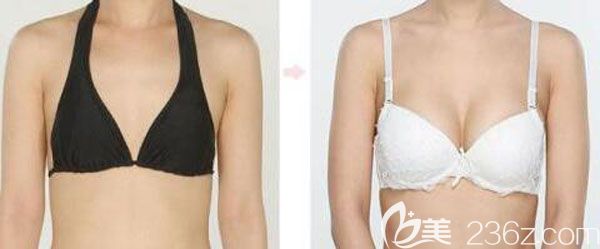 250cc曼托假體豐胸真人效果對(duì)比圖 250cc曼托假體豐胸真人效果對(duì)比圖