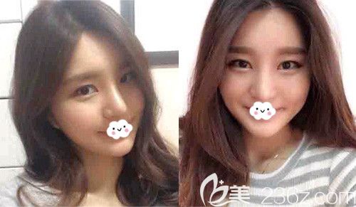 我找武漢卓美吳秀英做耳軟骨復(fù)合隆鼻價(jià)格比自體肋軟骨隆鼻費(fèi)用低不少呢！