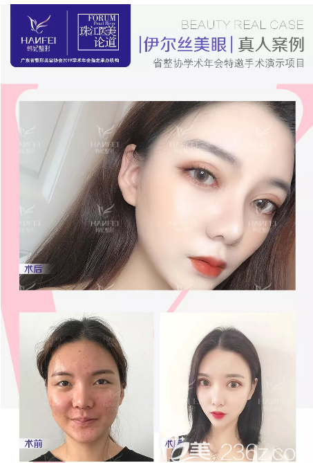 廣州韓妃李光琴雙眼皮案例 廣州韓妃李光琴雙眼皮案例