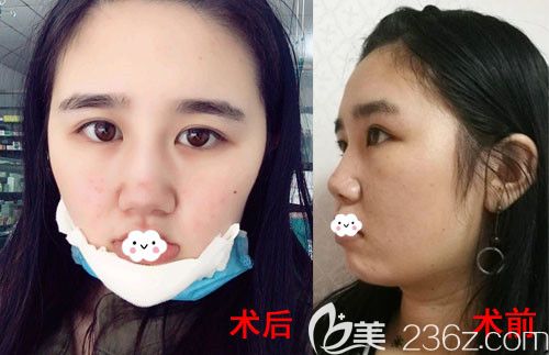 武漢卓美硅膠假體墊下巴術(shù)后第1天與術(shù)前對比圖