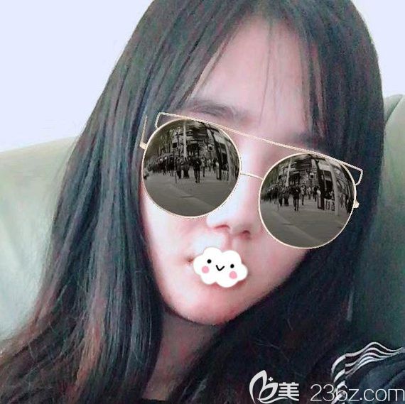 武漢卓美硅膠假體墊下巴術(shù)后第6天恢復(fù)效果圖