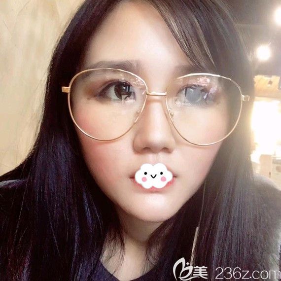 擔(dān)心脂肪玻尿酸吸收率問(wèn)題所以不后悔在武漢卓美做了硅膠假體墊下巴