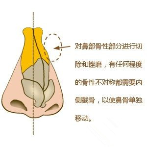 骨性歪鼻