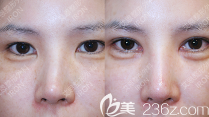 崔源哲院長歪鼻手術(shù)案例