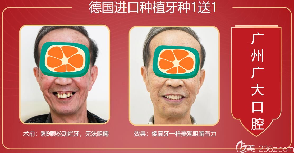 廣州廣大種植牙前后對(duì)比圖 廣州廣大種植牙前后對(duì)比圖