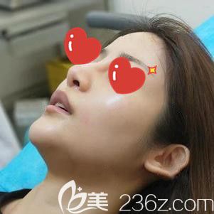 李杰醫(yī)生幫我做玻尿酸隆鼻術(shù)后即刻