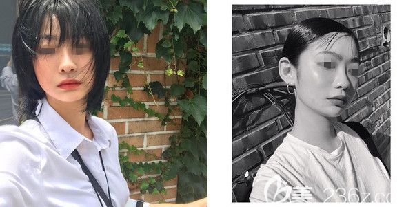 術(shù)前面診南京韓辰醫(yī)生咨詢嘴唇整形 術(shù)前面診南京韓辰醫(yī)生咨詢嘴唇整形