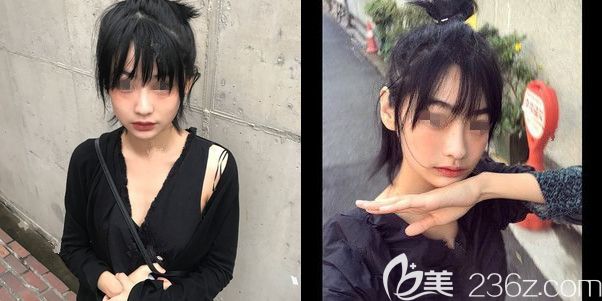 M唇術(shù)后一個(gè)月恢復(fù) M唇術(shù)后一個(gè)月恢復(fù)