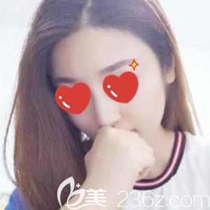 想隆鼻又害怕留疤，抱著試試看的態(tài)度選蕪湖壹加壹注射了玻尿酸